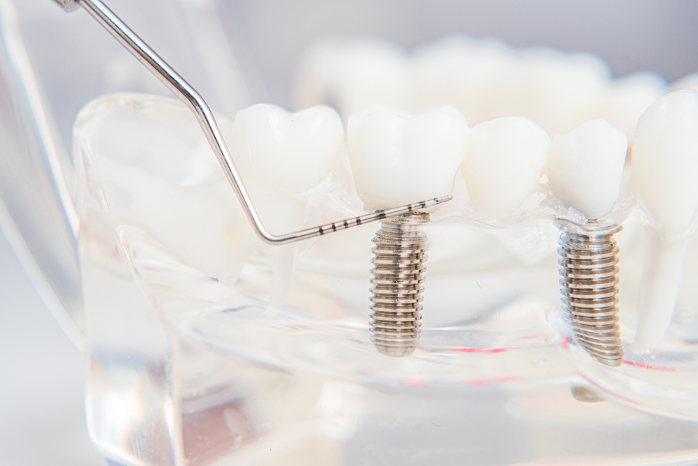 dental implants